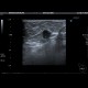 Marking of a breast tumour: US - Ultrasound